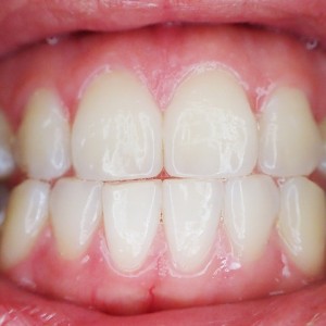 teeth-887338_640